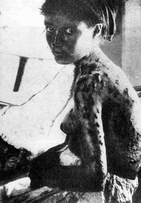 Mujer armenia con quemaduras y lesiones en el cuerpo, fruto de la tortura.